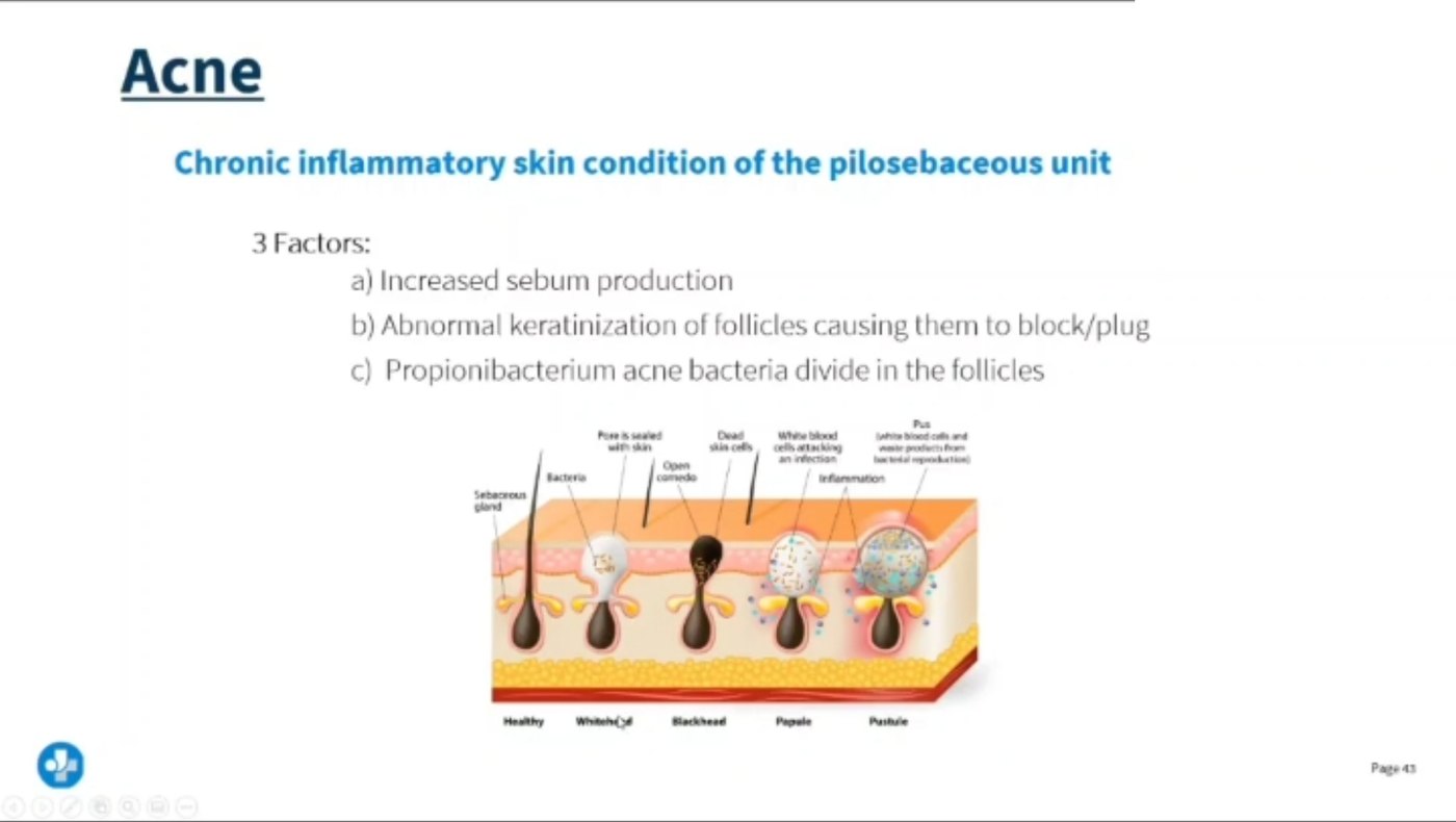 Lecture slide on acne describing a chronic inflammatory skin condition of the pilosebaceous unit with three factors: increased sebum production, abnormal keratinisation of follicles causing them to block or plug, and Propionibacterium acnes bacteria dividing in the follicles, with a cross-section showing healthy skin, whitehead, blackhead, papule and pustule.
