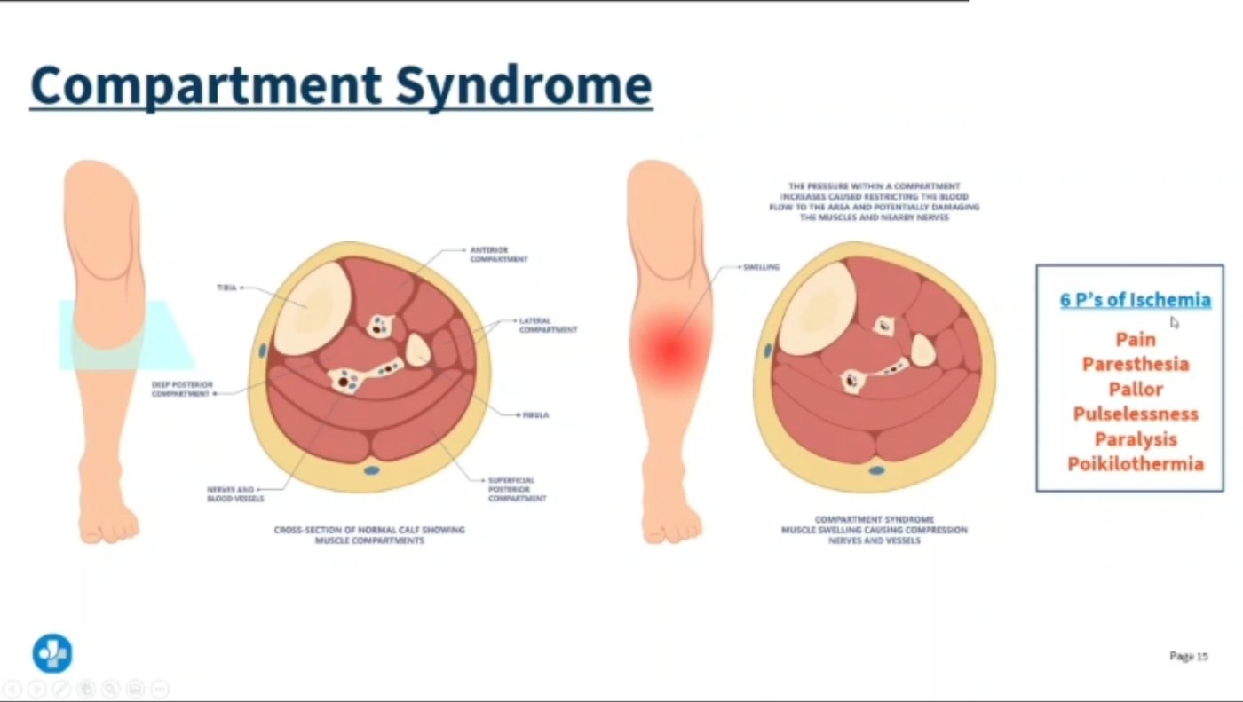Lecture slide on compartment syndrome showing a cross-section of the normal lower leg with its muscle compartments beside a swollen leg with a compartment under pressure, and the six Ps of ischemia: pain, paresthesia, pallor, pulselessness, paralysis and poikilothermia.