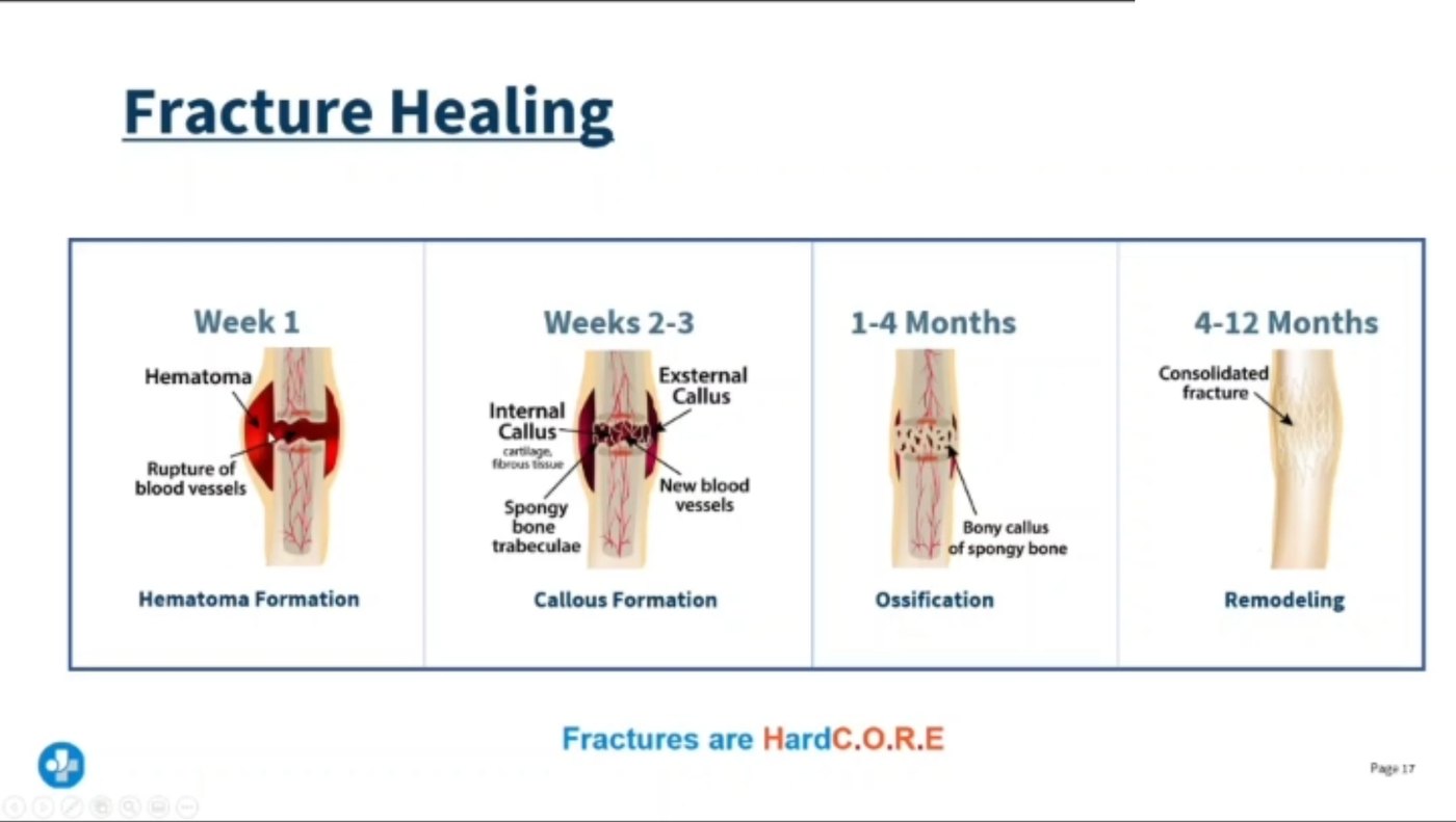Lecture slide on the four stages of fracture healing: hematoma formation in week one, callus formation at weeks two to three, ossification from one to four months, and remodeling from four to twelve months.