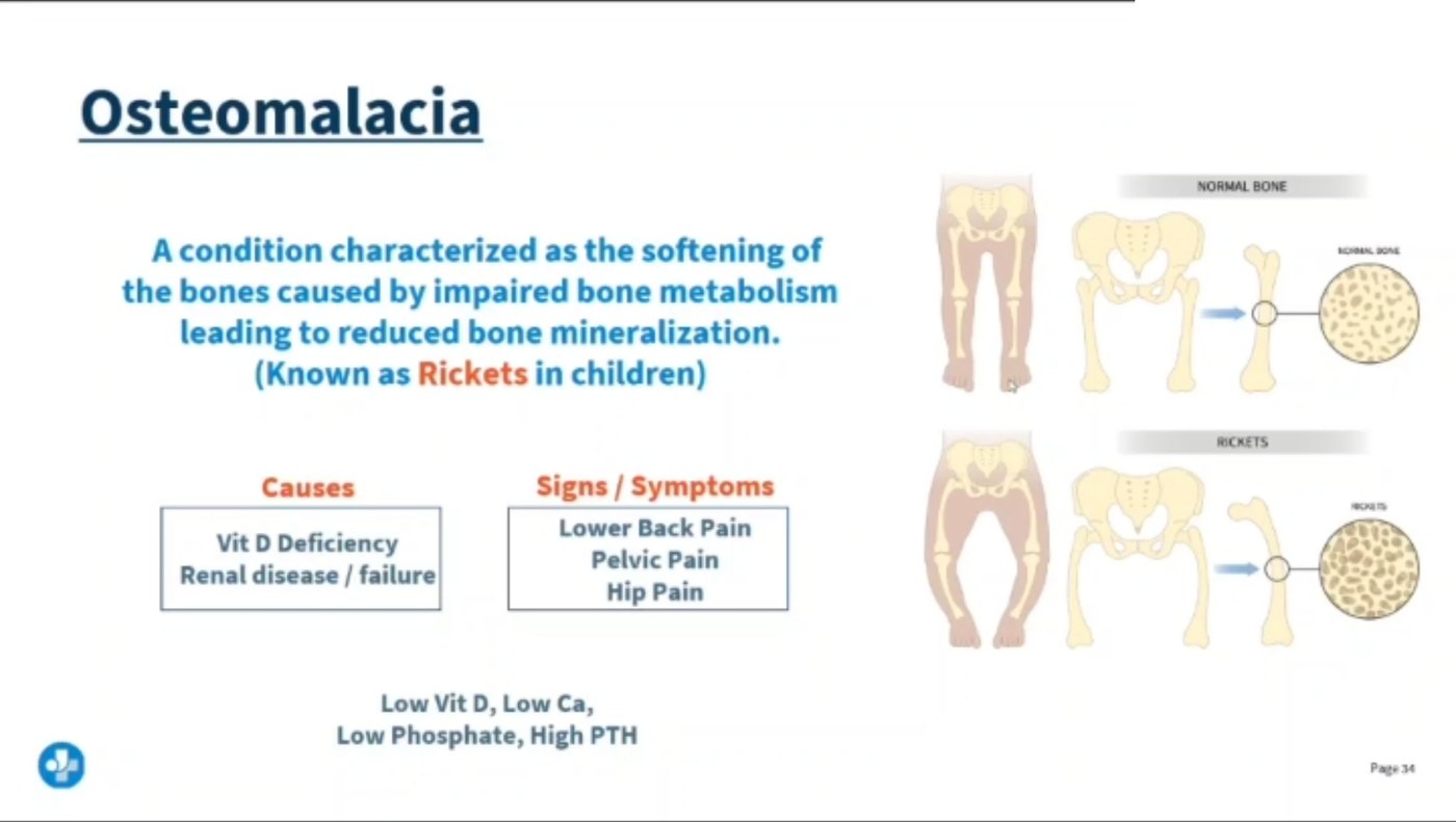 Lecture slide on osteomalacia describing softening of the bones from impaired bone metabolism and reduced mineralisation, known as rickets in children, with causes of vitamin D deficiency and renal disease, signs of lower back pain, pelvic pain and hip pain, and a comparison of normal bone with rachitic bone including bowed legs.
