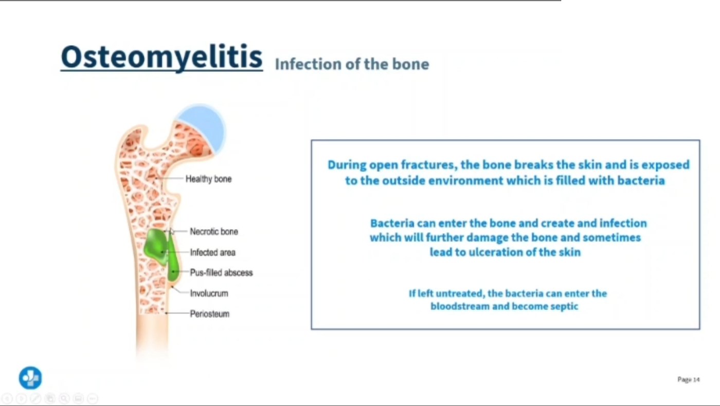 Lecture slide on osteomyelitis, an infection of the bone, showing healthy bone, necrotic bone, the infected area, a pus-filled abscess, involucrum and periosteum, with a note that in an open fracture the bone breaks the skin and is exposed to bacteria.