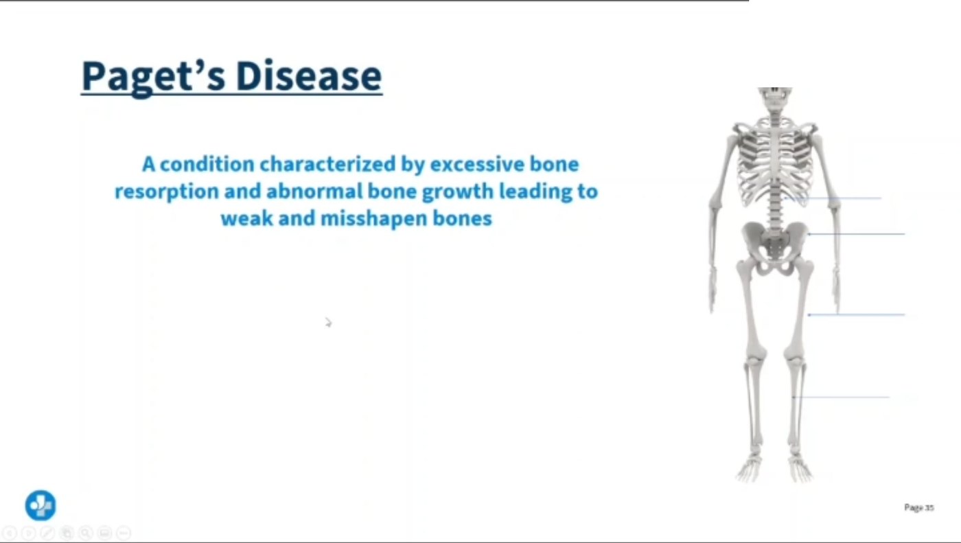 Lecture slide on Paget&rsquo;s disease describing excessive bone resorption and abnormal bone growth leading to weak and misshapen bones, illustrated on a full skeleton with the commonly affected sites indicated.