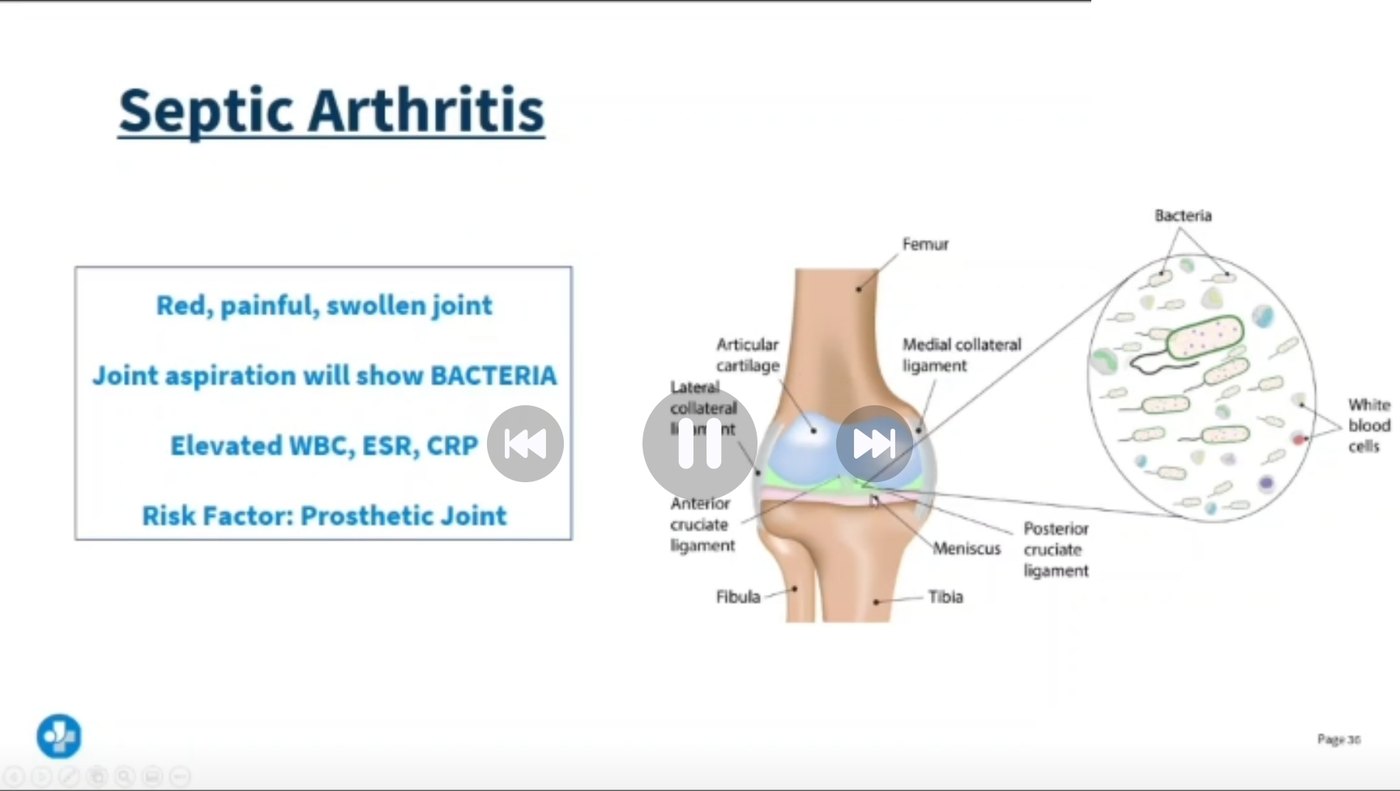 Lecture slide on septic arthritis listing a red, painful, swollen joint, joint aspiration showing bacteria, elevated white cell count, ESR and CRP, and a prosthetic joint as a risk factor, with a diagram of the knee joint anatomy and an inset of bacteria among white blood cells.